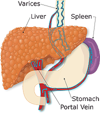 cirrhotic damage